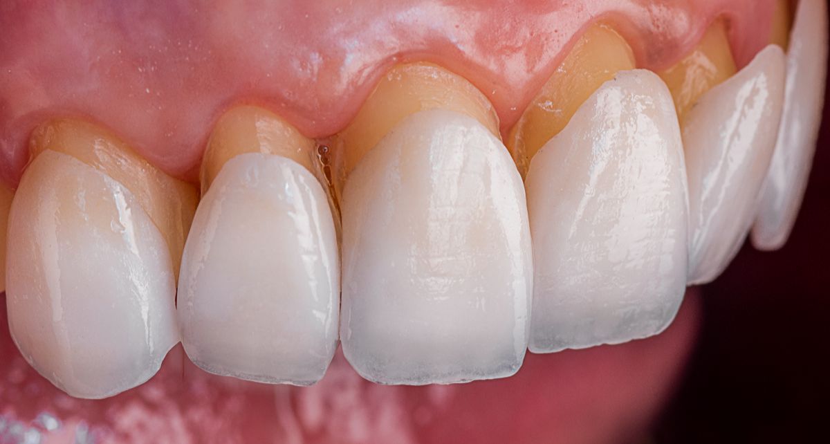 Discover the steps and procedures involved in creating a Hollywood smile. Explore the transformational journey to achieve a stunning Hollywood-style smile.