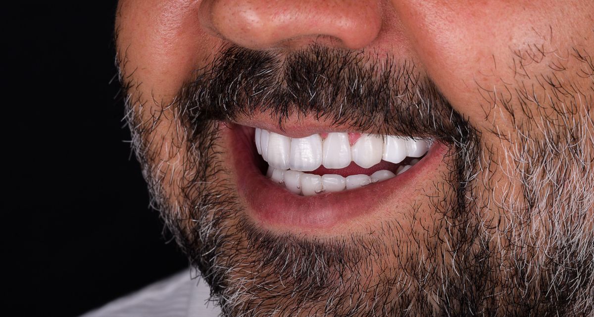 Dental Implants Illustrated Image