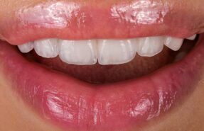 An informative image about dental veneers, covering uses, placement, advantages, and maintenance. Discover how veneers can enhance your smile and boost your confidence