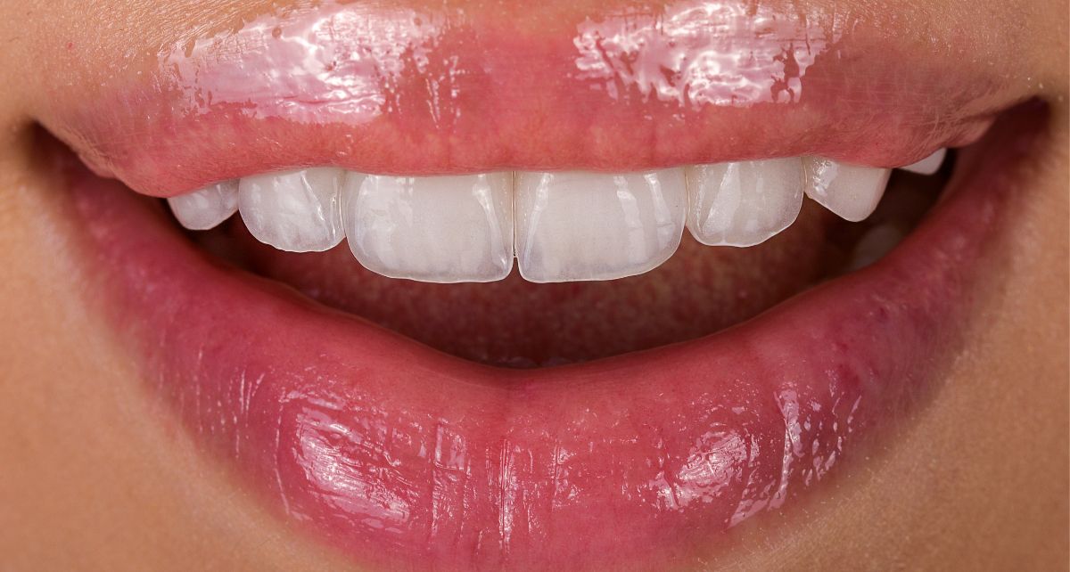 An informative image about dental veneers, covering uses, placement, advantages, and maintenance. Discover how veneers can enhance your smile and boost your confidence