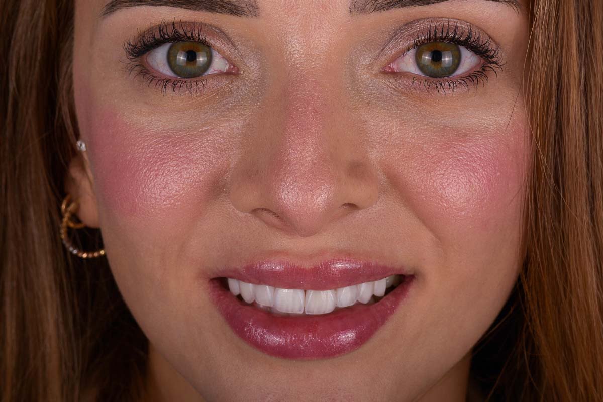 Discover cost-effective dental makeovers in Turkey for that Hollywood smile you've always wanted. Quality treatments, affordable prices. Your smile transformation awaits!