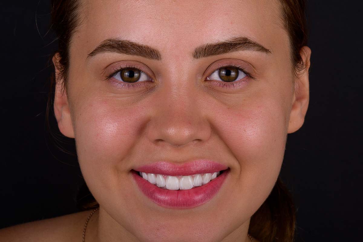 Enhance Your Smile: Hollywood Smile Turkey Treatment