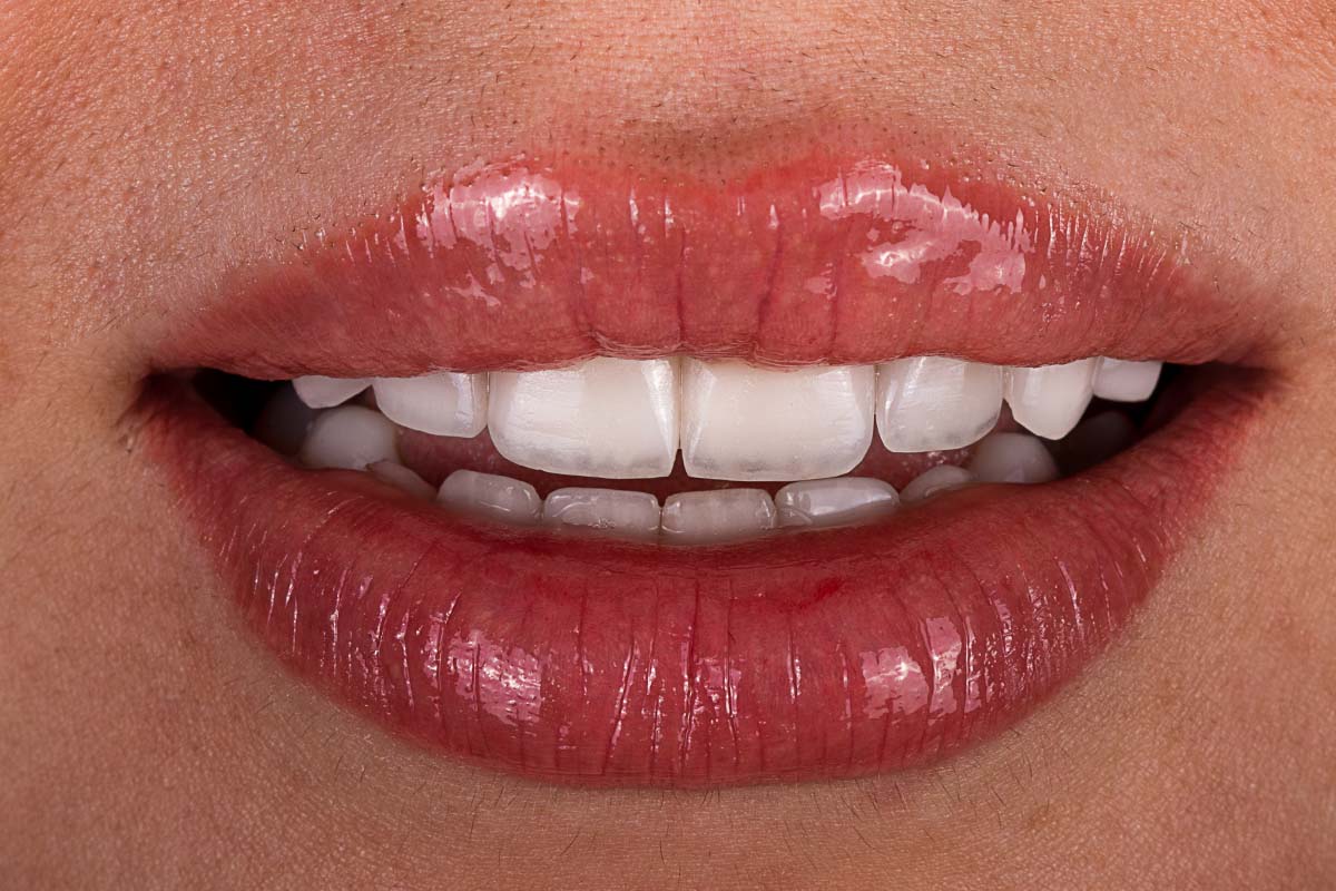 Discover the cost and options for achieving a Hollywood Smile Turkey Price. Explore the pricing details and options available for transforming your smile.